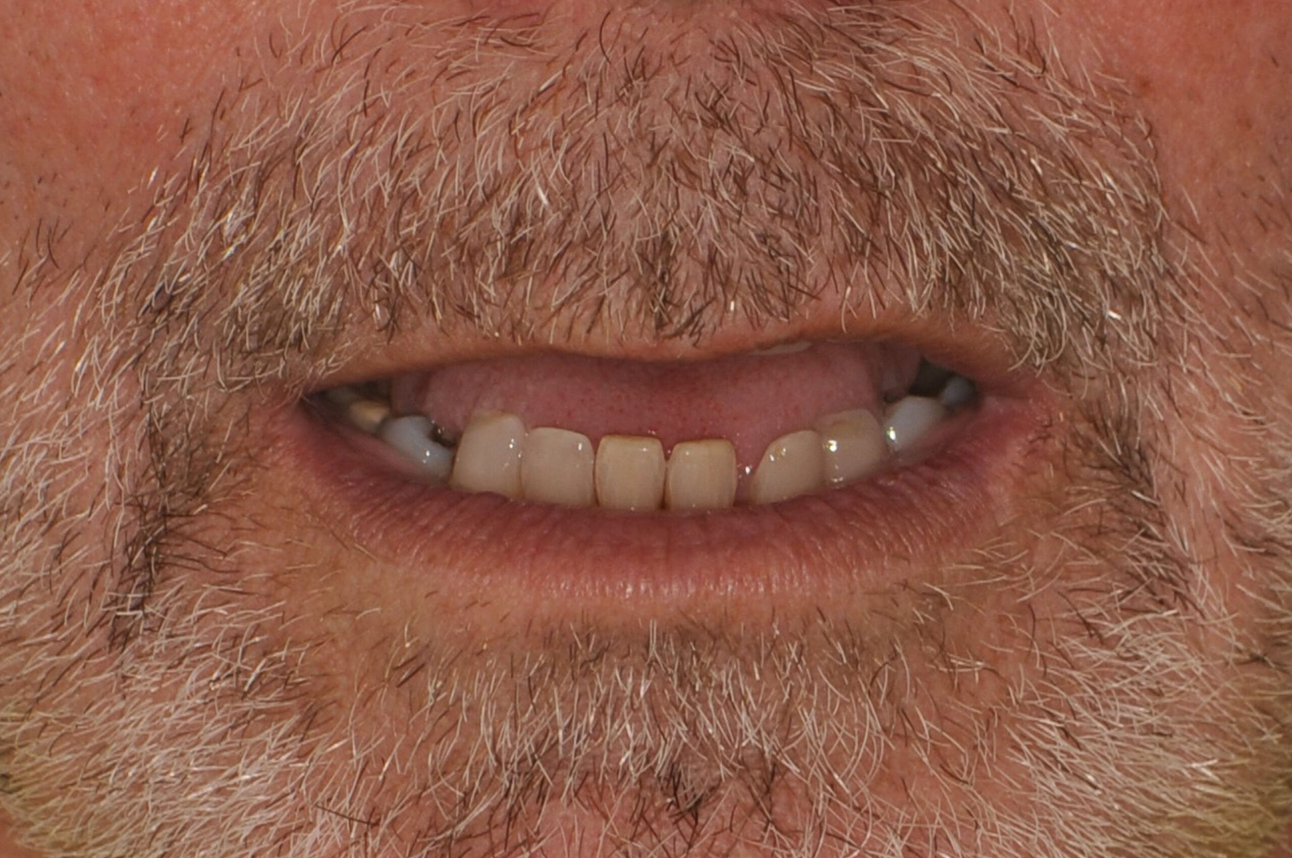 tooth implant surgery for a better smile