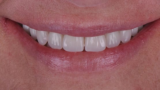 5 Hybrid Denture