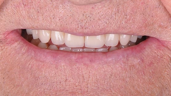6 Complete Denture and Implant Retained Denture
