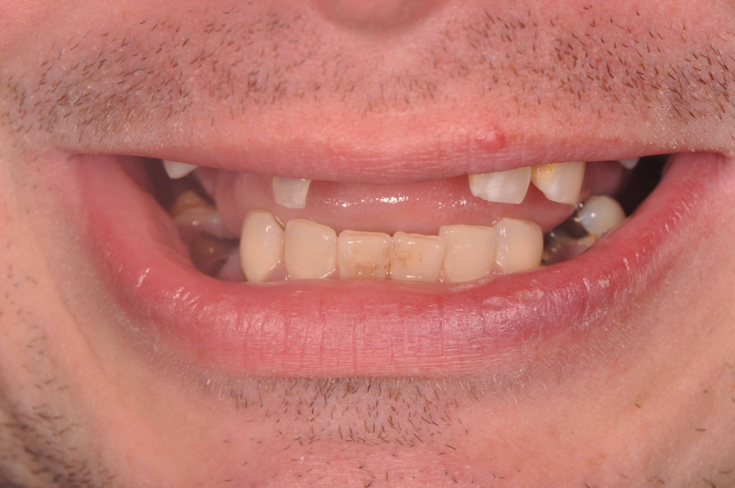 Charlotte NC tooth implant surgery for a better smile