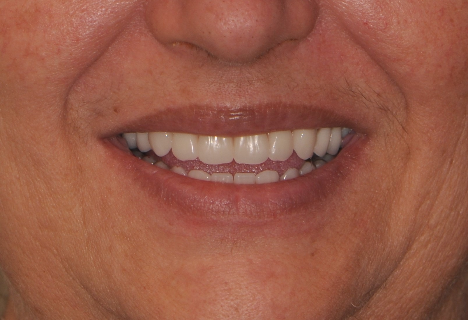 dental implants greenville sc