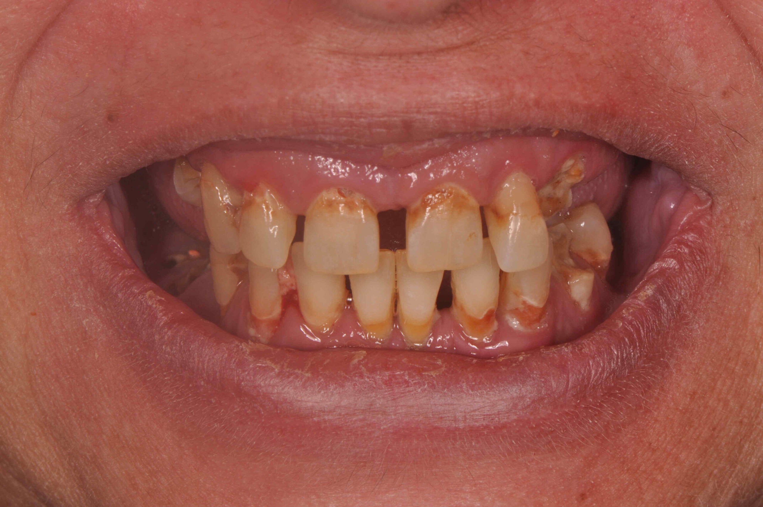 before tooth implant surgery