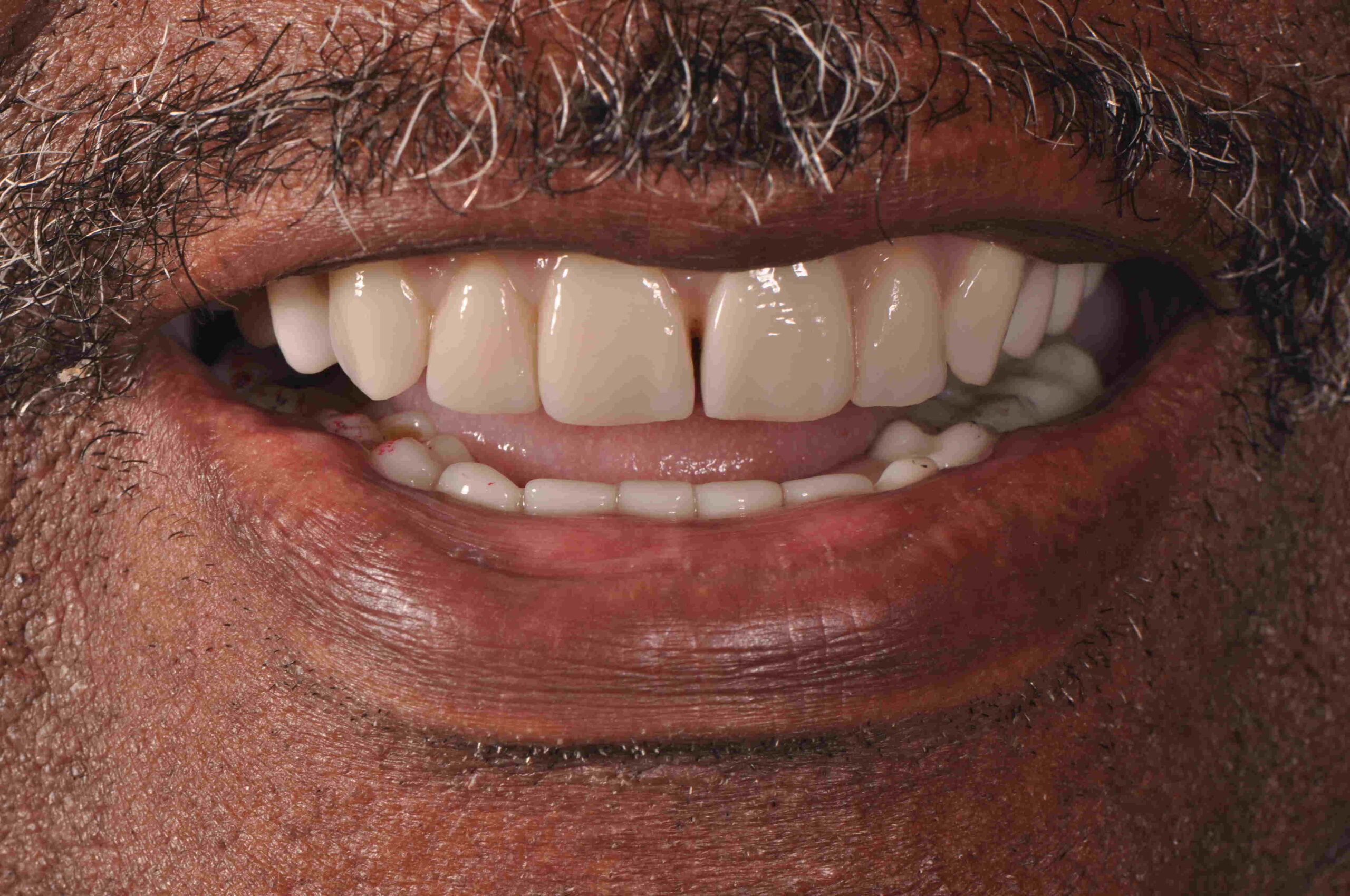 dental implants greenville sc