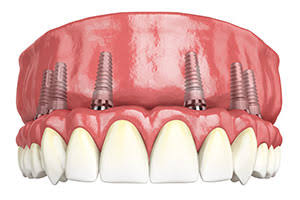 Full Arch Dental Implants Charlotte NC