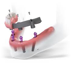 Dental Implants