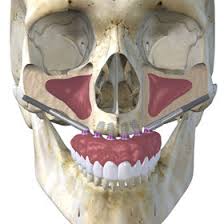 Image of a dental implant in human skeleton