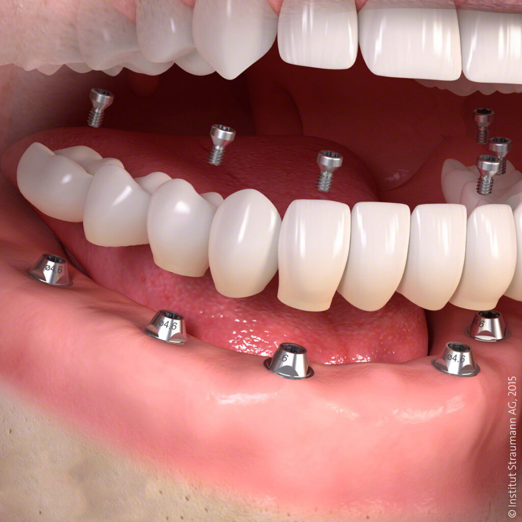 How a dental implant is applied